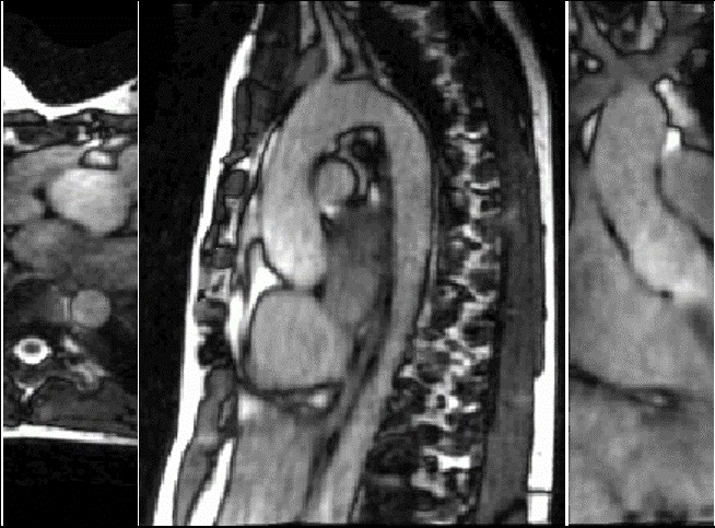 Figure 1: Detailed image 4D MRI of aortic motion