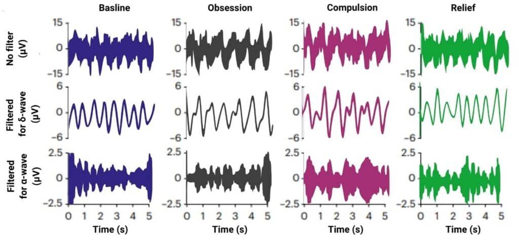 Brain activity across the entire neural network was measured during moments of obsession, compulsion & relief, compared to a baseline as reference. Various types of brain waves were observed, with alpha & delta waves appearing relatively frequently.