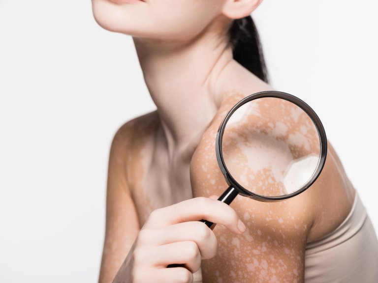 Can vitiligo enhance immunotherapy response in melanoma?
