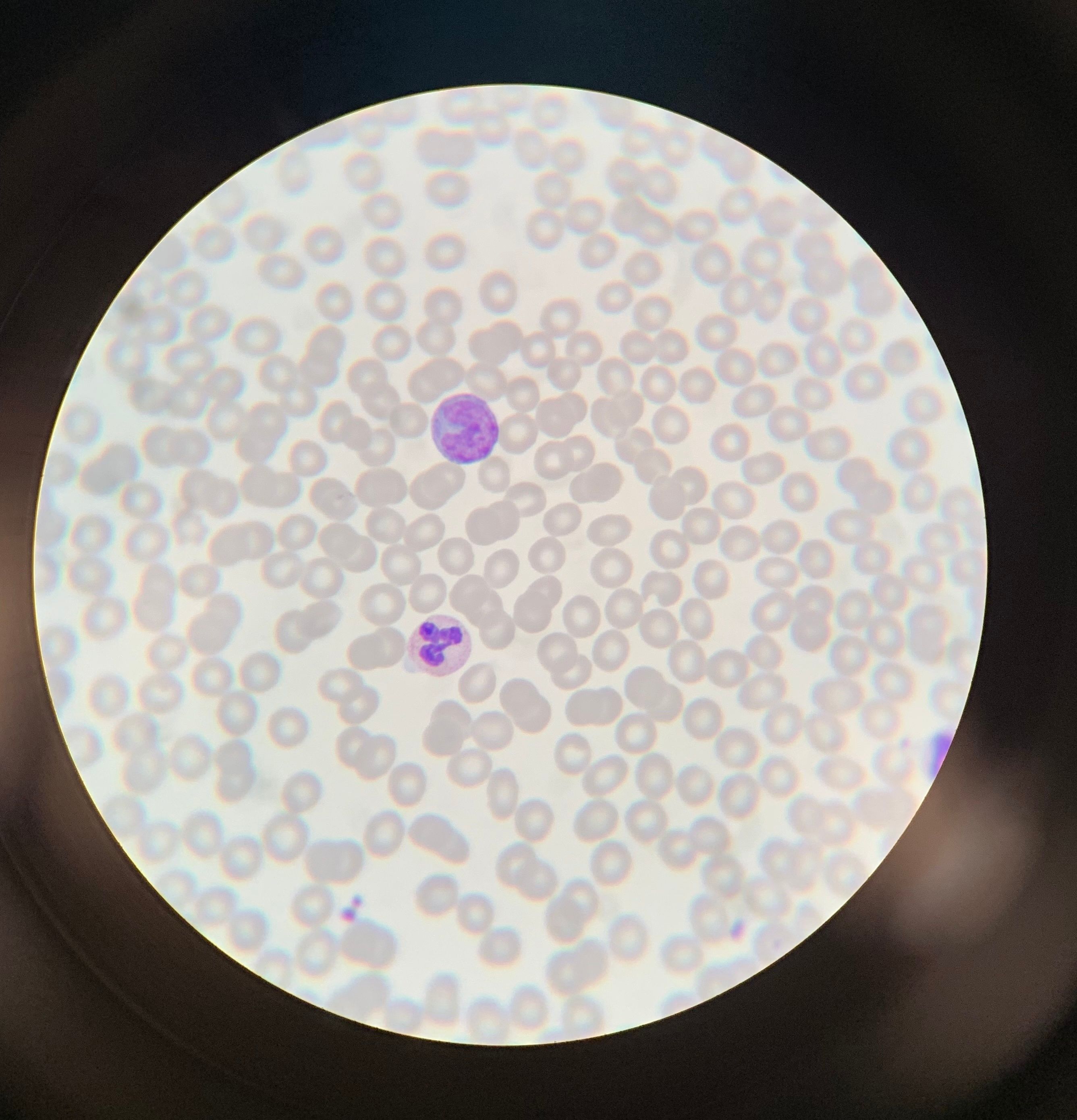 Vroege hiv-behandeling helpt slechts tijdelijk tegen ontregeling afweersysteem