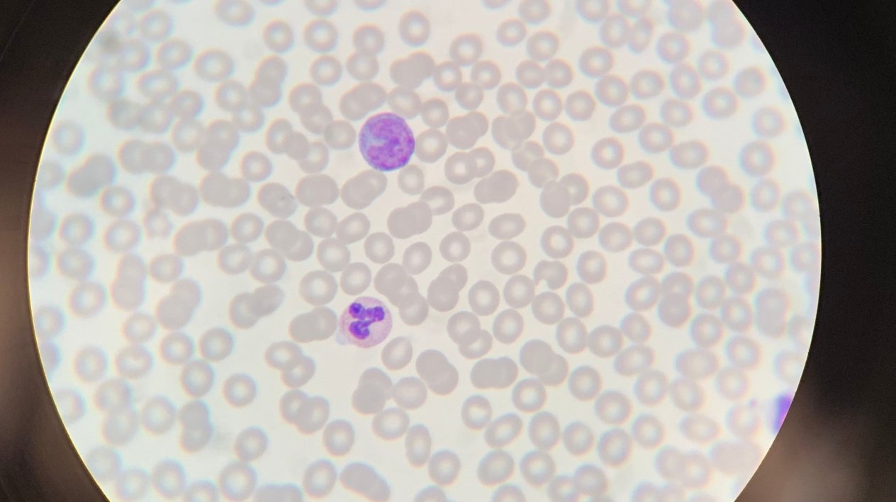 Temporary benefit for immune system in early HIV treatment, but dysregulation returns