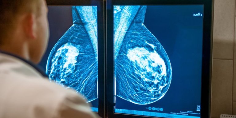 Minder bijwerkingen en kosten door slim inzetten medicijn bij uitgezaaide borstkanker