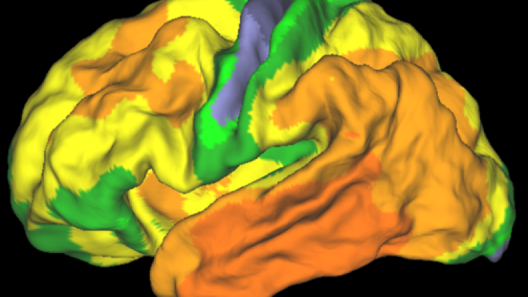 Hersenen met veel tau-eiwit (hoe 'heter' de kleuren, hoe meer tau-eiwit).