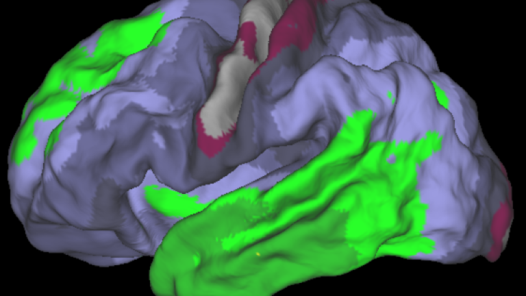 PET-scan van de hersenen met weinig tau-eiwit. 
