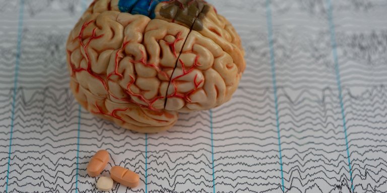 Predicting epilepsy after rare stroke