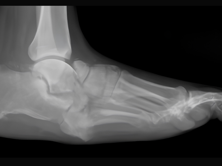 Exploring the role of biomechanics in Charcot neuro-osteoarthropathy and midfoot deformity
