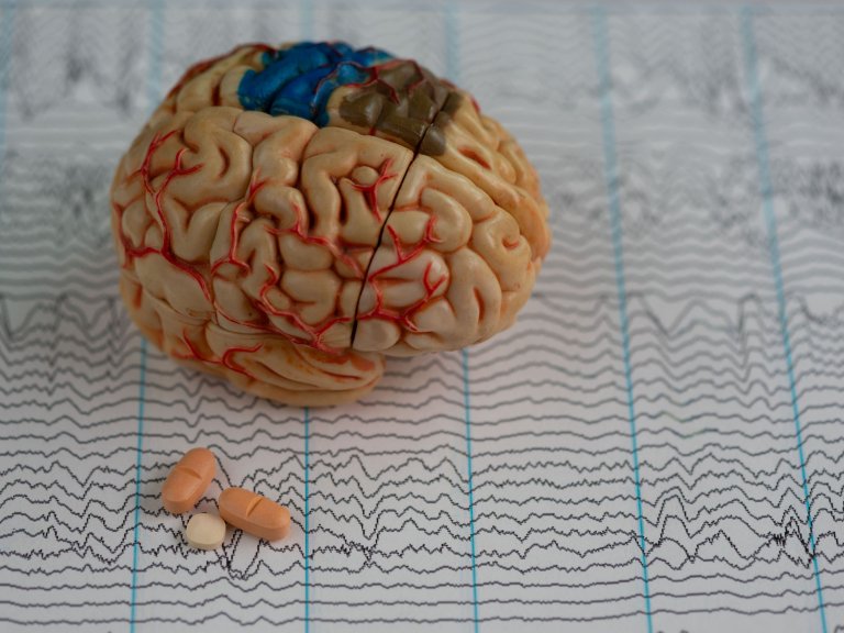 Predicting epilepsy after rare stroke