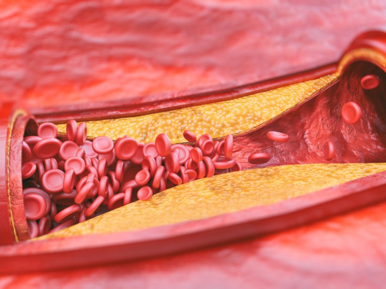 Developing immunotherapy for atherosclerosis: a challenging adventure