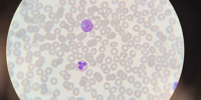 Temporary benefit for immune system in early HIV treatment, but dysregulation returns