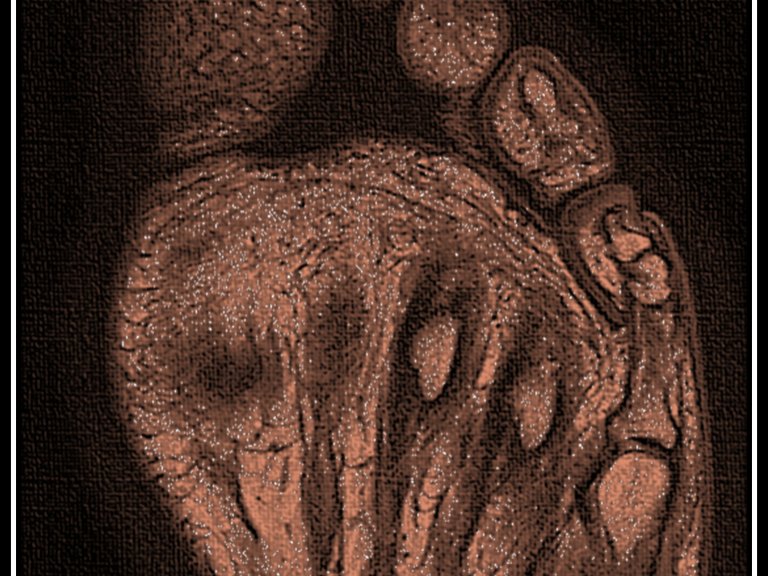 Imaging and biomechanics of plantar foot soft tissues in association with foot ulcer risk in diabetes