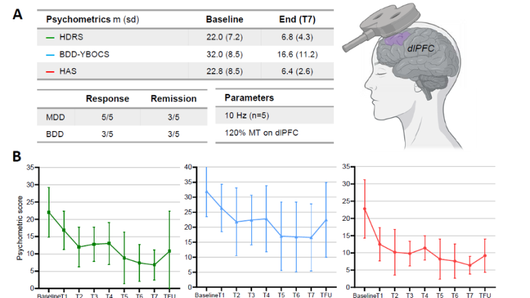 Repetitive Transcranial Magnetic Stimulation (rTMS) of the left dorsolateral prefrontal cortex (dlPFC) in five patients with BDD and Major Depressive Disorder (MDD).   